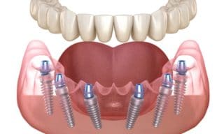 All On 6 Dental Implants